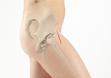 Anterior Hip Replacement