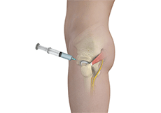 Hip Injections