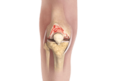 Osteoarthritis of the Knee