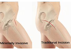 Minimally Invasive Total Hip Replacement