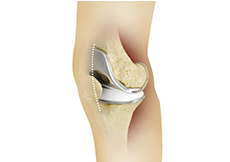 Minimally Invasive Total Knee Arthroplasty