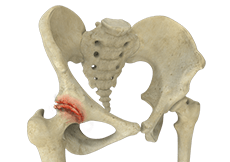 Osteoarthritis of the Hip