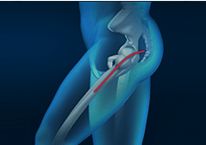 Posterior Hip Replacement