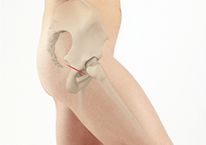 Superior Hip Replacement (Supercap/SuperPath)