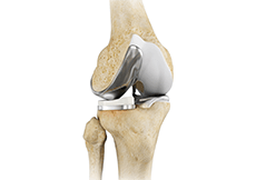 Unicompartmental Knee Replacement